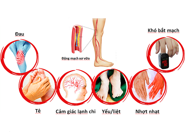 Bệnh động mạch ngoại biên thường gây ảnh hưởng rõ rệt trên hai chân