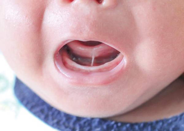Dính thắng lưỡi ảnh hưởng trực tiếp đến hoạt động nuốt và phát âm của trẻ.