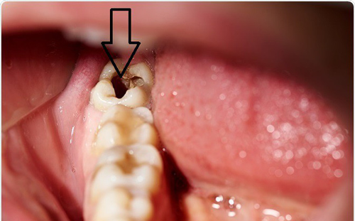Cách phòng ngừa răng bị sâu và các lỗ sâu răng