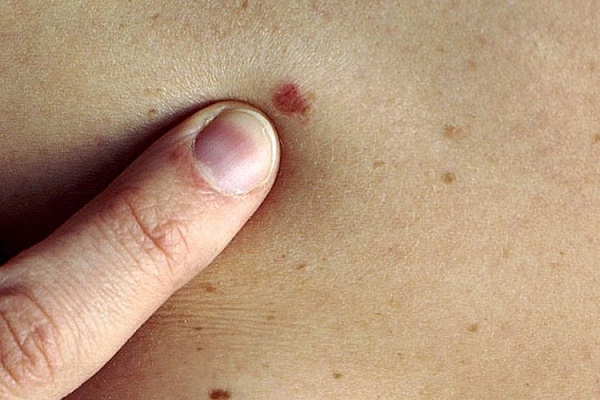 Biểu hiện của ung thư da