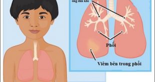 Điều cần biết về căn bệnh viêm phổi cộng đồng ở trẻ nhỏ