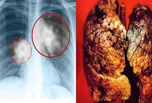 Ung thư phổi cướp đi sinh mạng của hơn 20.000 người tại Việt Nam mỗi năm