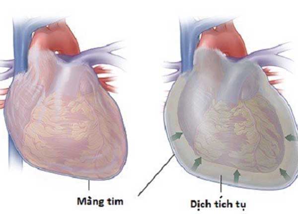 Tràn dịch màng tim là sự tích tụ dịch trong lớp màng đôi