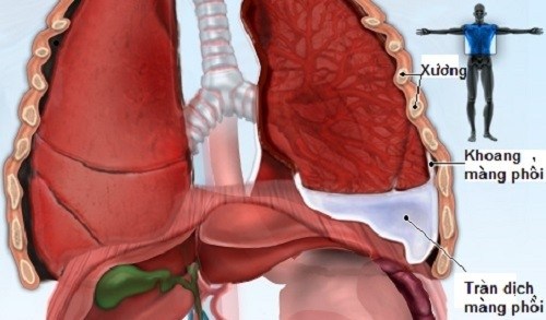 Các cách điều trị bệnh tràn dịch màng phổi