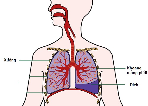 Bệnh tràn dịch màng phổi có thể dẫn đến chết người nếu không chữa kịp thời