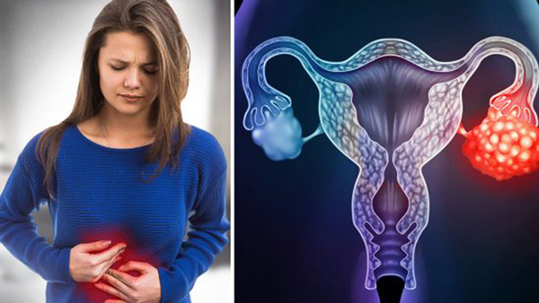 Khi bị ung thư buồng trứng người bệnh thường có biểu hiện đau bụng, to bụng