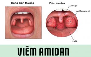 Thông tin về bệnh viêm amidan