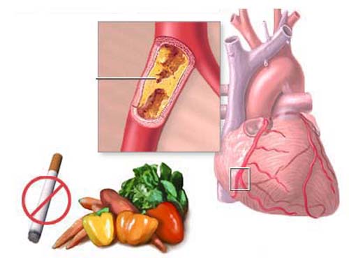 Làm thế nào để phòng ngừa bệnh viêm cơ tim hiệu quả nhất