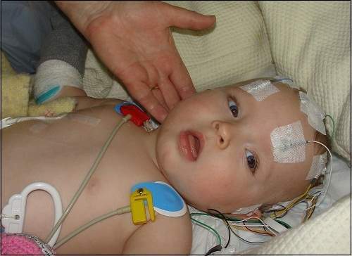 Điều trị viêm màng não mủ cho trẻ nhỏ